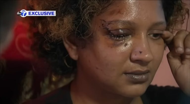 NYC woman will lose eye after being attacked on subway