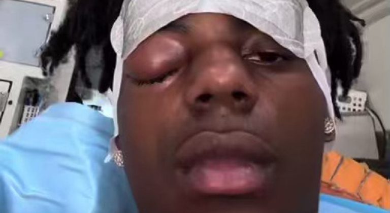 IShowSpeed's eyes are swollen shut and he's rushing to surgery