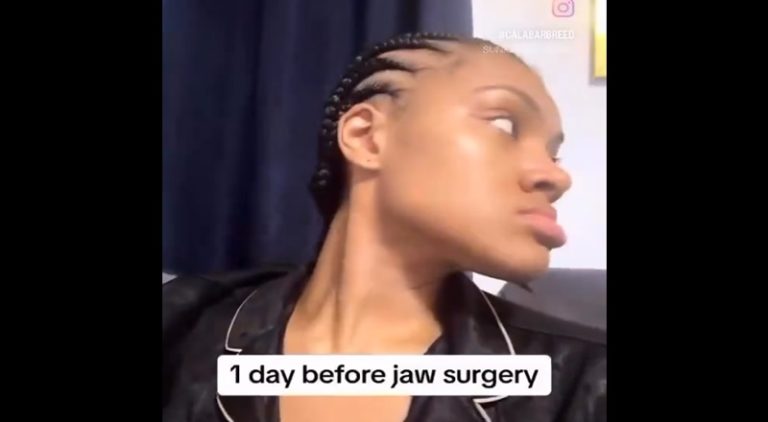 Woman had jaw surgery removing underbite and shares journey